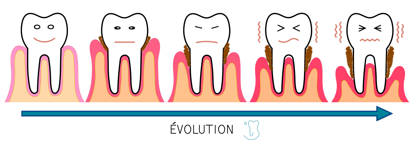 parodontite schéma de l'évolution de la maladie