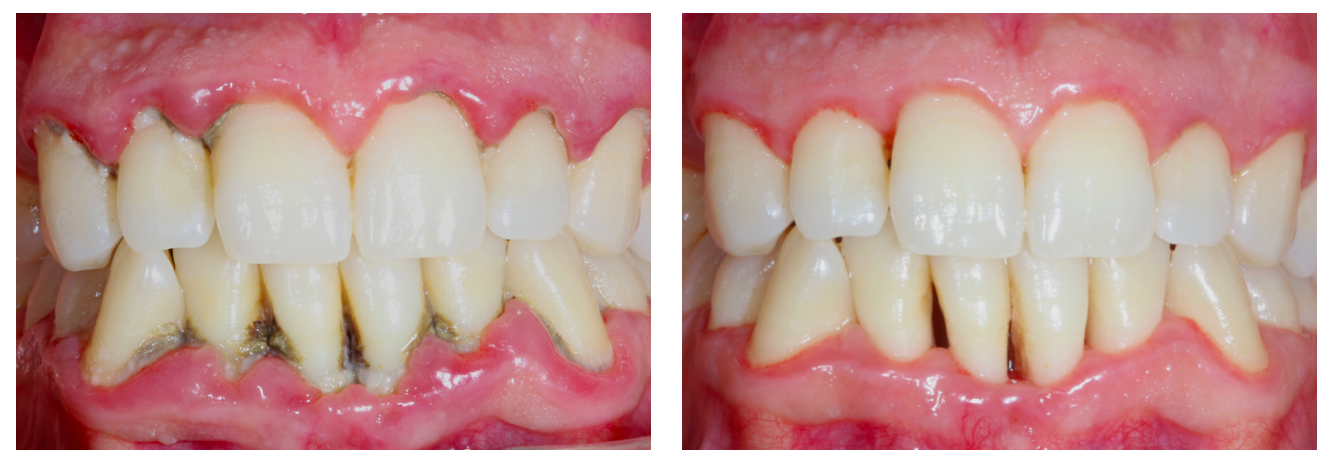 Patient avant-après traitement parodontal