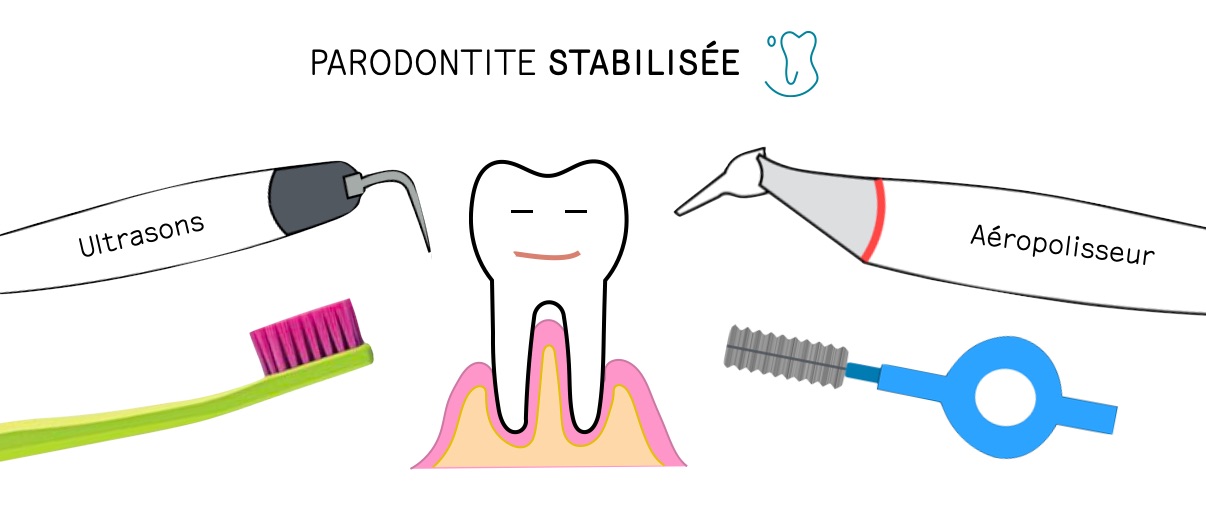 parodontite stabilisée